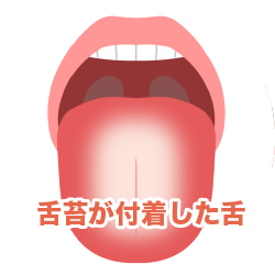 舌苔が付着した舌